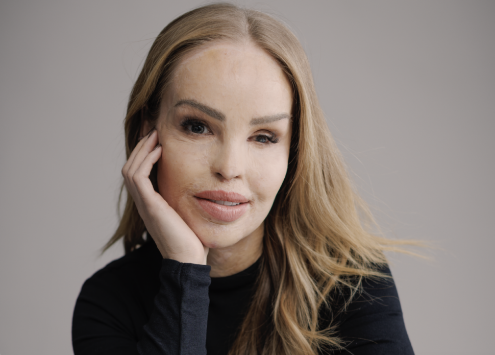 Still Beautiful Katie Piper